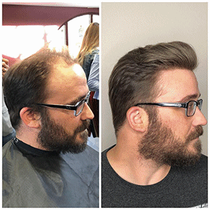 Hair Replacement, Hair Enhancement